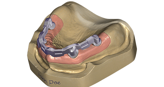 exocad Bar (Perpetual Upgrade)