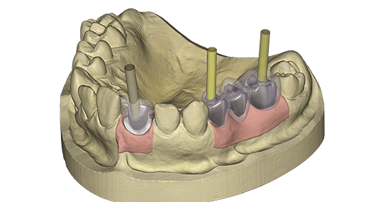 exocad Implant (Perpetual Upgrade)