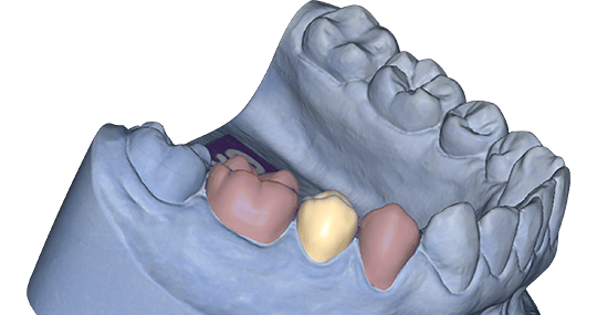 exocad Provisional (Flex Upgrade)