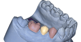 exocad Provisional (Flex Upgrade)